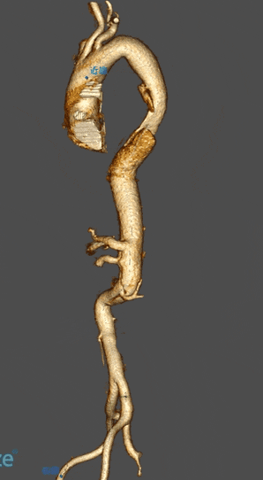 动脉长鞘怎么置入宁波市第二医院血管外科运用Castor®单分支支架结合长鞘建立导丝通路的方法治疗Stanford B型胸主动脉夹层一例_https://www.jmylbn.com_新闻资讯_第3张