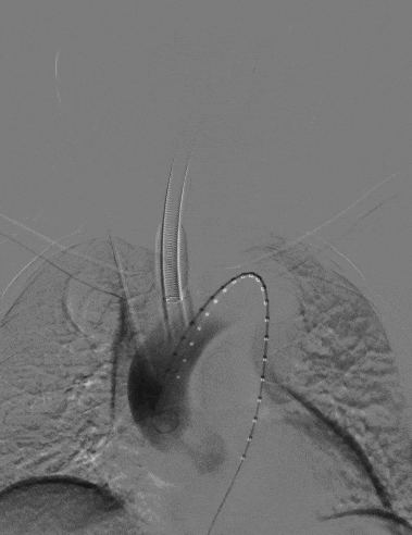 动脉长鞘怎么置入宁波市第二医院血管外科运用Castor®单分支支架结合长鞘建立导丝通路的方法治疗Stanford B型胸主动脉夹层一例_https://www.jmylbn.com_新闻资讯_第7张