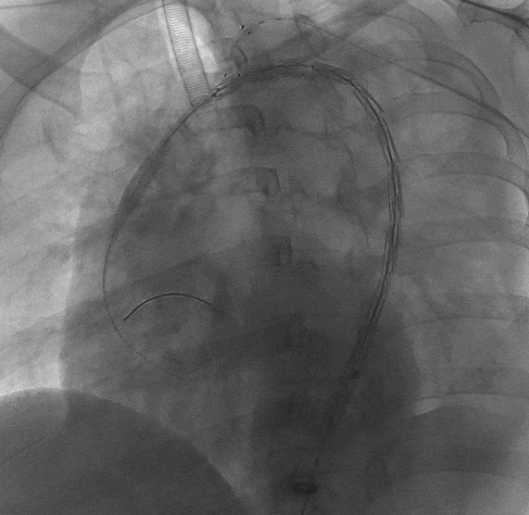 动脉长鞘怎么置入宁波市第二医院血管外科运用Castor®单分支支架结合长鞘建立导丝通路的方法治疗Stanford B型胸主动脉夹层一例_https://www.jmylbn.com_新闻资讯_第10张