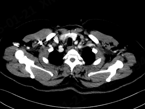 动脉长鞘怎么置入宁波市第二医院血管外科运用Castor®单分支支架结合长鞘建立导丝通路的方法治疗Stanford B型胸主动脉夹层一例_https://www.jmylbn.com_新闻资讯_第4张