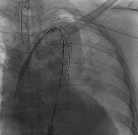 动脉长鞘怎么置入宁波市第二医院血管外科运用Castor®单分支支架结合长鞘建立导丝通路的方法治疗Stanford B型胸主动脉夹层一例_https://www.jmylbn.com_新闻资讯_第11张