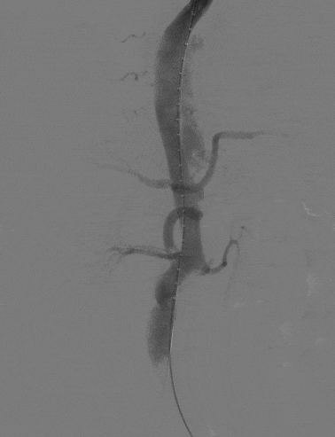 动脉长鞘怎么置入宁波市第二医院血管外科运用Castor®单分支支架结合长鞘建立导丝通路的方法治疗Stanford B型胸主动脉夹层一例_https://www.jmylbn.com_新闻资讯_第13张