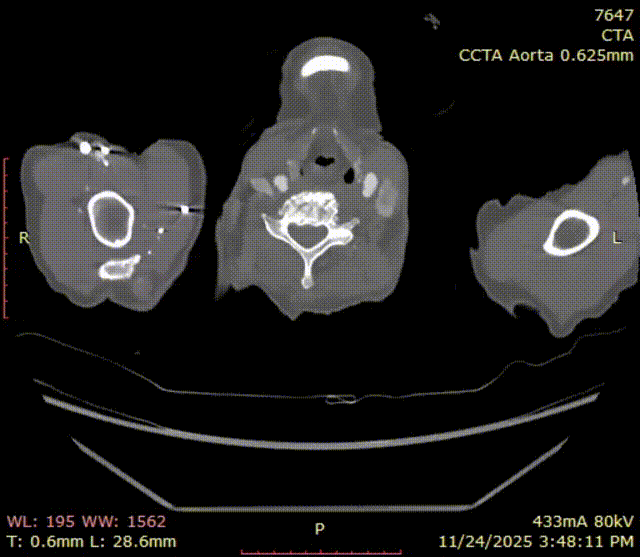 斑马导丝是治疗什么的「胸有乾坤」至简至易 行之有效—— Zone 0 TBE植入治疗弓部动脉瘤病例报道_https://www.jmylbn.com_新闻资讯_第27张