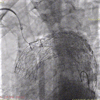 斑马导丝是治疗什么的「胸有乾坤」至简至易 行之有效—— Zone 0 TBE植入治疗弓部动脉瘤病例报道_https://www.jmylbn.com_新闻资讯_第21张