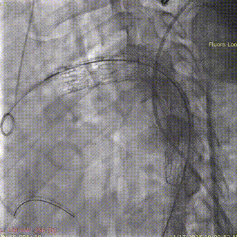 斑马导丝是治疗什么的「胸有乾坤」至简至易 行之有效—— Zone 0 TBE植入治疗弓部动脉瘤病例报道_https://www.jmylbn.com_新闻资讯_第14张