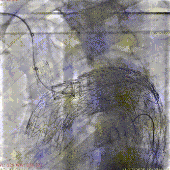 斑马导丝是治疗什么的「胸有乾坤」至简至易 行之有效—— Zone 0 TBE植入治疗弓部动脉瘤病例报道_https://www.jmylbn.com_新闻资讯_第23张