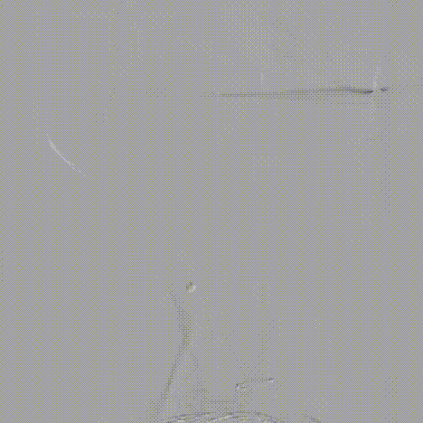 斑马导丝是治疗什么的「胸有乾坤」至简至易 行之有效—— Zone 0 TBE植入治疗弓部动脉瘤病例报道_https://www.jmylbn.com_新闻资讯_第25张