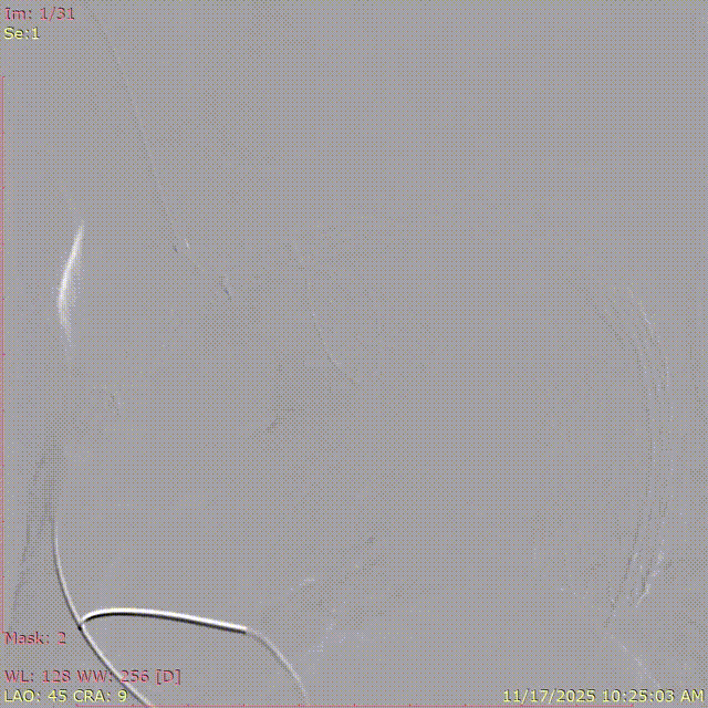 斑马导丝是治疗什么的「胸有乾坤」至简至易 行之有效—— Zone 0 TBE植入治疗弓部动脉瘤病例报道_https://www.jmylbn.com_新闻资讯_第19张