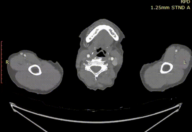 斑马导丝是治疗什么的「胸有乾坤」至简至易 行之有效—— Zone 0 TBE植入治疗弓部动脉瘤病例报道_https://www.jmylbn.com_新闻资讯_第6张