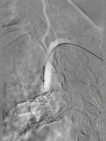 斑马导丝是治疗什么的「胸有乾坤」至简至易 行之有效—— Zone 0 TBE植入治疗弓部动脉瘤病例报道_https://www.jmylbn.com_新闻资讯_第26张