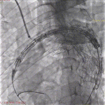斑马导丝是治疗什么的「胸有乾坤」至简至易 行之有效—— Zone 0 TBE植入治疗弓部动脉瘤病例报道_https://www.jmylbn.com_新闻资讯_第20张