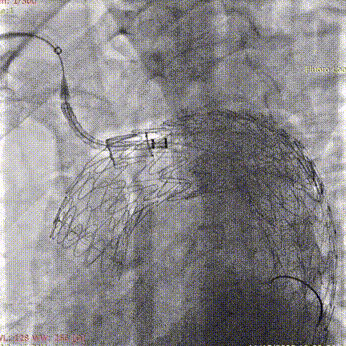 斑马导丝是治疗什么的「胸有乾坤」至简至易 行之有效—— Zone 0 TBE植入治疗弓部动脉瘤病例报道_https://www.jmylbn.com_新闻资讯_第22张