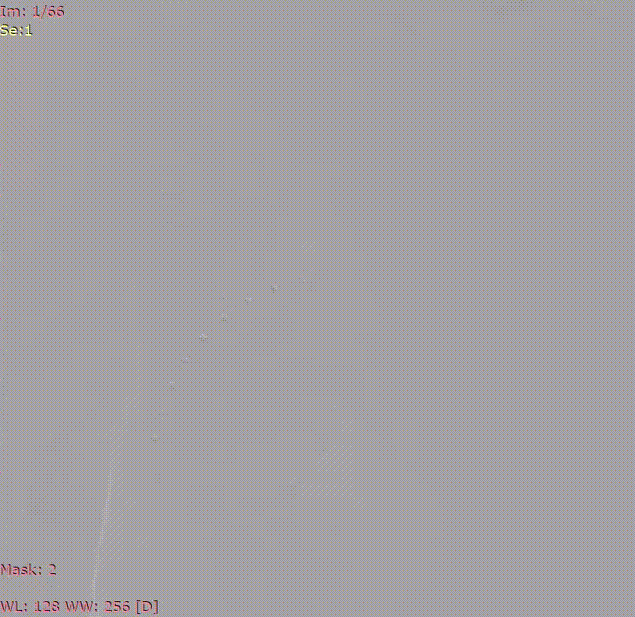 斑马导丝是治疗什么的「胸有乾坤」至简至易 行之有效—— Zone 0 TBE植入治疗弓部动脉瘤病例报道_https://www.jmylbn.com_新闻资讯_第13张