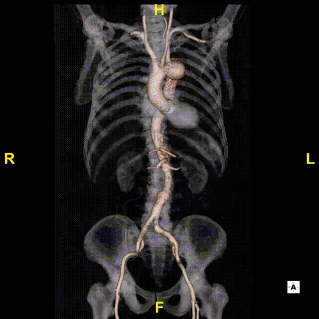 斑马导丝是治疗什么的「胸有乾坤」至简至易 行之有效—— Zone 0 TBE植入治疗弓部动脉瘤病例报道_https://www.jmylbn.com_新闻资讯_第7张