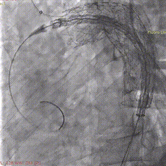 斑马导丝是治疗什么的「胸有乾坤」至简至易 行之有效—— Zone 0 TBE植入治疗弓部动脉瘤病例报道_https://www.jmylbn.com_新闻资讯_第18张