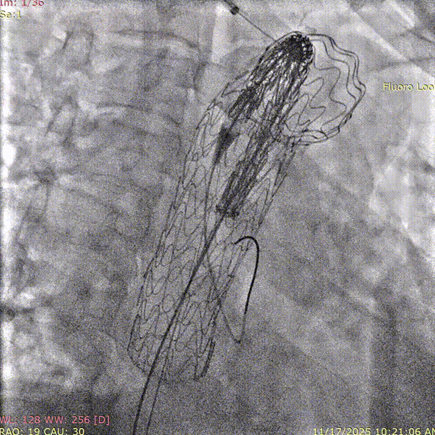 斑马导丝是治疗什么的「胸有乾坤」至简至易 行之有效—— Zone 0 TBE植入治疗弓部动脉瘤病例报道_https://www.jmylbn.com_新闻资讯_第17张