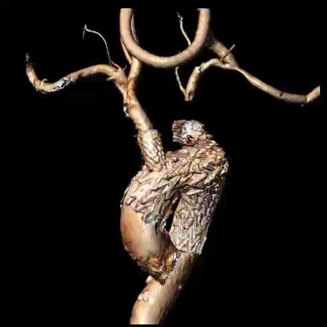 斑马导丝是治疗什么的「胸有乾坤」至简至易 行之有效—— Zone 0 TBE植入治疗弓部动脉瘤病例报道_https://www.jmylbn.com_新闻资讯_第28张