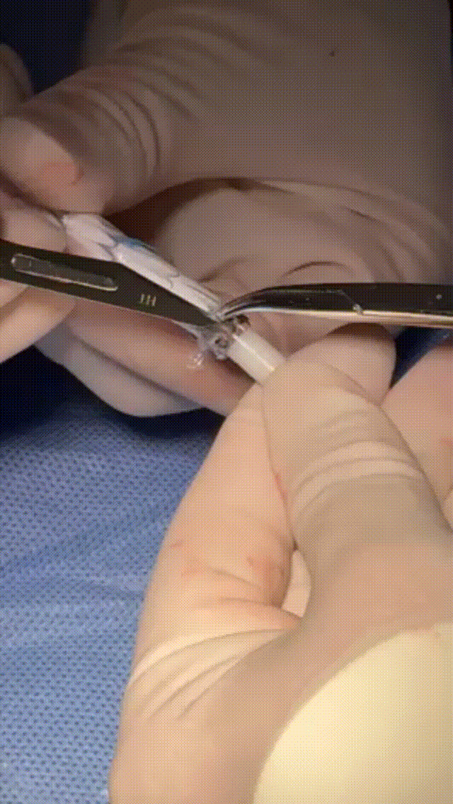 gore医疗怎么样「胸有乾坤」可调可控 从容不迫——GORE® TAG® 可主动调控胸主动脉覆膜支架治疗巨大胸主动脉瘤病例报道_https://www.jmylbn.com_新闻资讯_第21张