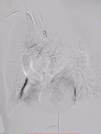 gore医疗怎么样「胸有乾坤」可调可控 从容不迫——GORE® TAG® 可主动调控胸主动脉覆膜支架治疗巨大胸主动脉瘤病例报道_https://www.jmylbn.com_新闻资讯_第29张