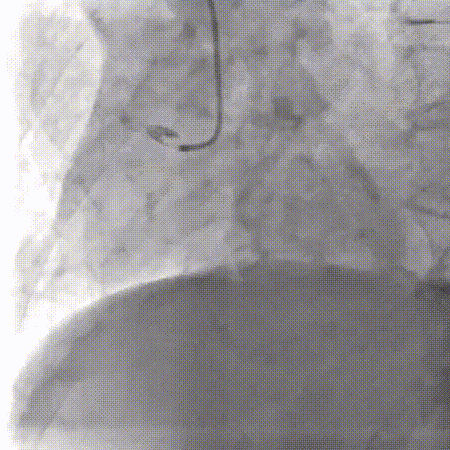 gore医疗怎么样「胸有乾坤」可调可控 从容不迫——GORE® TAG® 可主动调控胸主动脉覆膜支架治疗巨大胸主动脉瘤病例报道_https://www.jmylbn.com_新闻资讯_第16张
