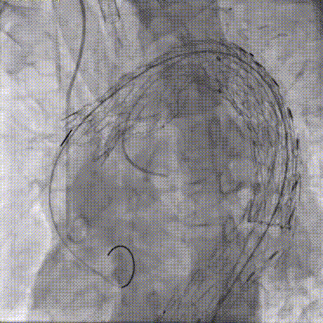 gore医疗怎么样「胸有乾坤」可调可控 从容不迫——GORE® TAG® 可主动调控胸主动脉覆膜支架治疗巨大胸主动脉瘤病例报道_https://www.jmylbn.com_新闻资讯_第28张