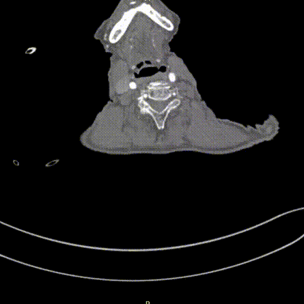 gore医疗怎么样「胸有乾坤」可调可控 从容不迫——GORE® TAG® 可主动调控胸主动脉覆膜支架治疗巨大胸主动脉瘤病例报道_https://www.jmylbn.com_新闻资讯_第6张