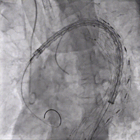 gore医疗怎么样「胸有乾坤」可调可控 从容不迫——GORE® TAG® 可主动调控胸主动脉覆膜支架治疗巨大胸主动脉瘤病例报道_https://www.jmylbn.com_新闻资讯_第23张