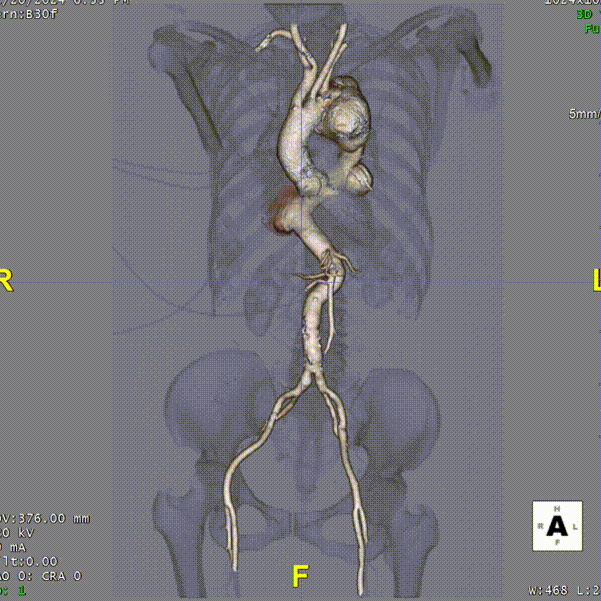 gore医疗怎么样「胸有乾坤」可调可控 从容不迫——GORE® TAG® 可主动调控胸主动脉覆膜支架治疗巨大胸主动脉瘤病例报道_https://www.jmylbn.com_新闻资讯_第7张