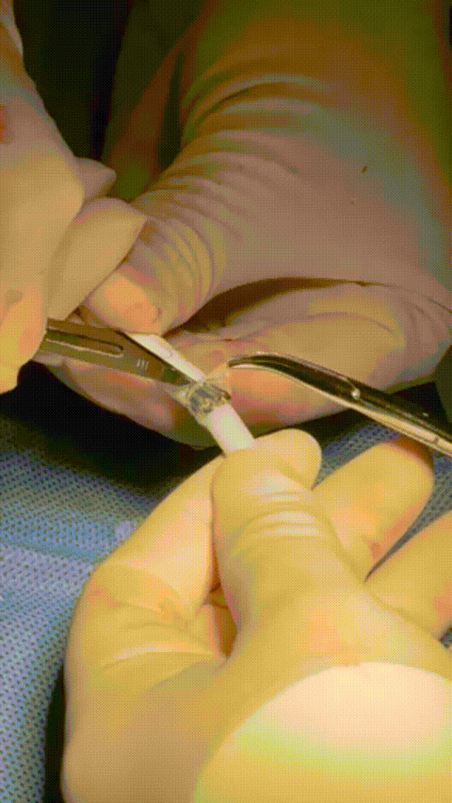 gore医疗怎么样「胸有乾坤」可调可控 从容不迫——GORE® TAG® 可主动调控胸主动脉覆膜支架治疗巨大胸主动脉瘤病例报道_https://www.jmylbn.com_新闻资讯_第20张