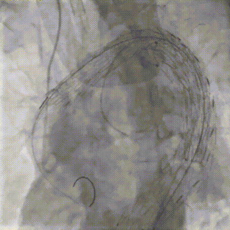 gore医疗怎么样「胸有乾坤」可调可控 从容不迫——GORE® TAG® 可主动调控胸主动脉覆膜支架治疗巨大胸主动脉瘤病例报道_https://www.jmylbn.com_新闻资讯_第27张