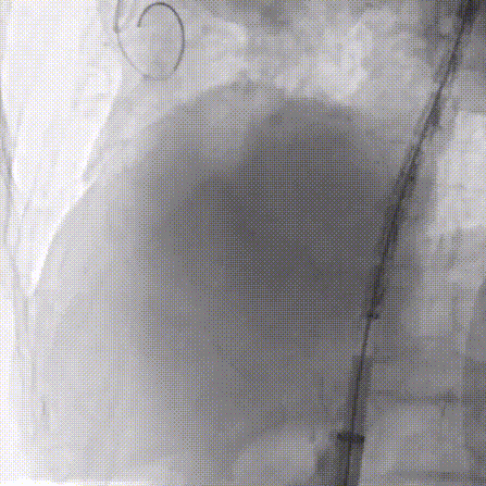 gore医疗怎么样「胸有乾坤」可调可控 从容不迫——GORE® TAG® 可主动调控胸主动脉覆膜支架治疗巨大胸主动脉瘤病例报道_https://www.jmylbn.com_新闻资讯_第19张