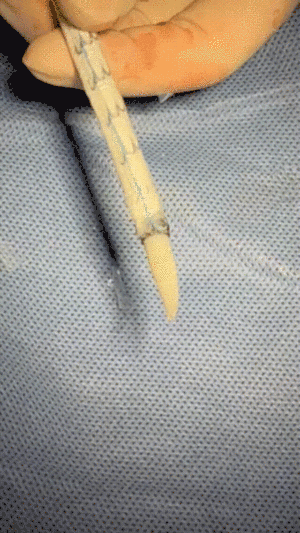 gore医疗怎么样「胸有乾坤」可调可控 从容不迫——GORE® TAG® 可主动调控胸主动脉覆膜支架治疗巨大胸主动脉瘤病例报道_https://www.jmylbn.com_新闻资讯_第22张