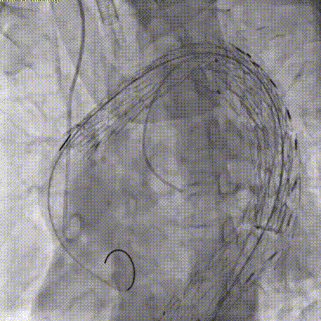 gore医疗怎么样「胸有乾坤」可调可控 从容不迫——GORE® TAG® 可主动调控胸主动脉覆膜支架治疗巨大胸主动脉瘤病例报道_https://www.jmylbn.com_新闻资讯_第26张