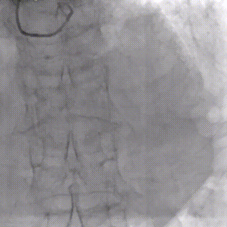 gore医疗怎么样「胸有乾坤」可调可控 从容不迫——GORE® TAG® 可主动调控胸主动脉覆膜支架治疗巨大胸主动脉瘤病例报道_https://www.jmylbn.com_新闻资讯_第15张