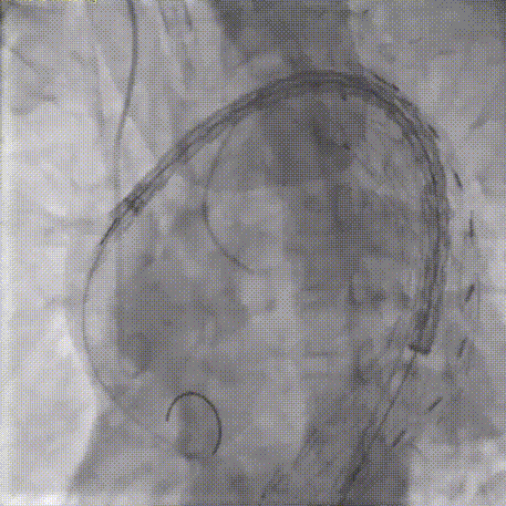 gore医疗怎么样「胸有乾坤」可调可控 从容不迫——GORE® TAG® 可主动调控胸主动脉覆膜支架治疗巨大胸主动脉瘤病例报道_https://www.jmylbn.com_新闻资讯_第25张