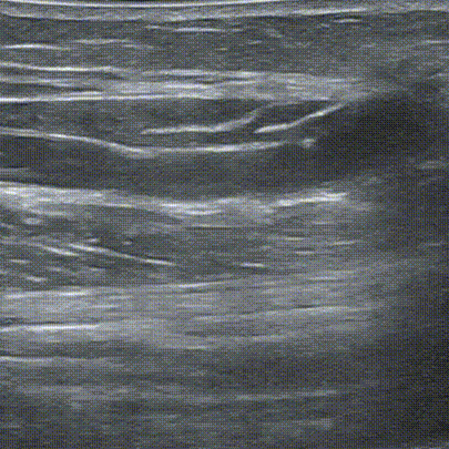 pta在医学上什么意思鼎例相助 ｜ 张和平教授团队：刻痕药涂球囊的应用体会_https://www.jmylbn.com_新闻资讯_第13张