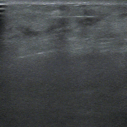 pta在医学上什么意思鼎例相助 ｜ 张和平教授团队：刻痕药涂球囊的应用体会_https://www.jmylbn.com_新闻资讯_第15张