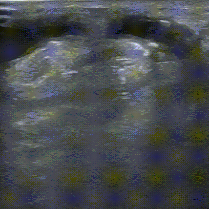 pta在医学上什么意思鼎例相助 ｜ 张和平教授团队：刻痕药涂球囊的应用体会_https://www.jmylbn.com_新闻资讯_第16张