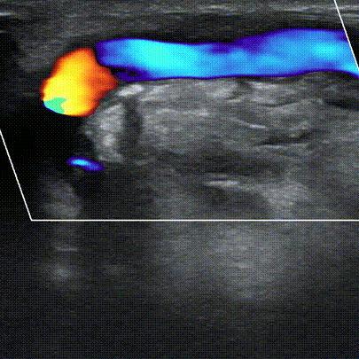 pta在医学上什么意思鼎例相助 ｜ 张和平教授团队：刻痕药涂球囊的应用体会_https://www.jmylbn.com_新闻资讯_第18张