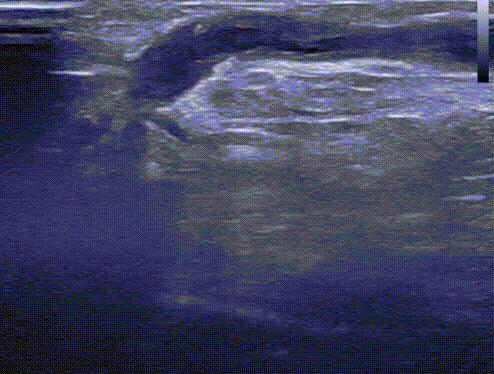 pta在医学上什么意思鼎例相助 ｜ 张和平教授团队：刻痕药涂球囊的应用体会_https://www.jmylbn.com_新闻资讯_第4张