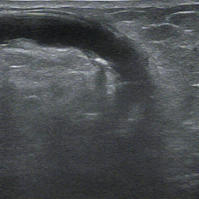 pta在医学上什么意思鼎例相助 ｜ 张和平教授团队：刻痕药涂球囊的应用体会_https://www.jmylbn.com_新闻资讯_第9张