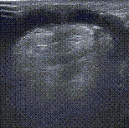 pta在医学上什么意思鼎例相助 ｜ 张和平教授团队：刻痕药涂球囊的应用体会_https://www.jmylbn.com_新闻资讯_第17张