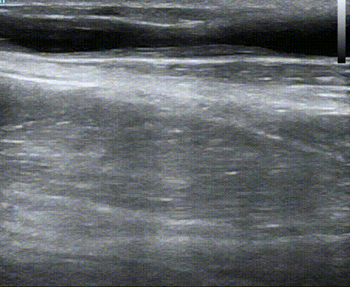 pta在医学上什么意思鼎例相助 ｜ 张和平教授团队：刻痕药涂球囊的应用体会_https://www.jmylbn.com_新闻资讯_第5张