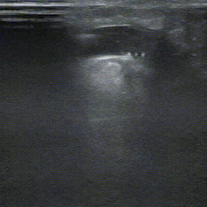 pta在医学上什么意思鼎例相助 ｜ 张和平教授团队：刻痕药涂球囊的应用体会_https://www.jmylbn.com_新闻资讯_第8张