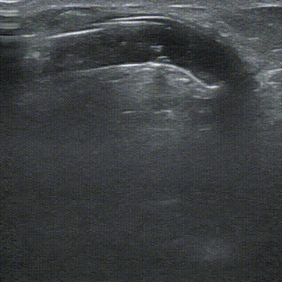 pta在医学上什么意思鼎例相助 ｜ 张和平教授团队：刻痕药涂球囊的应用体会_https://www.jmylbn.com_新闻资讯_第14张