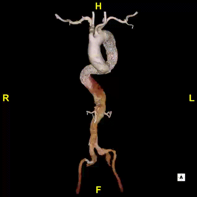 gore医疗怎么样「胸有乾坤」危如累卵 妙手回春——Conformable GORE®TAG®胸主动脉覆膜支架应用于高龄急性主动脉夹层治疗_https://www.jmylbn.com_新闻资讯_第42张