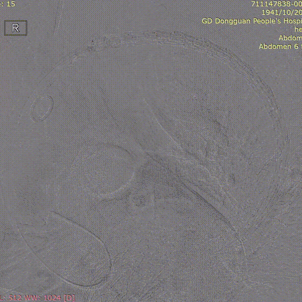 gore医疗怎么样「胸有乾坤」危如累卵 妙手回春——Conformable GORE®TAG®胸主动脉覆膜支架应用于高龄急性主动脉夹层治疗_https://www.jmylbn.com_新闻资讯_第30张
