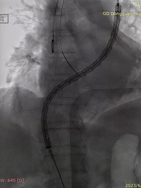 gore医疗怎么样「胸有乾坤」危如累卵 妙手回春——Conformable GORE®TAG®胸主动脉覆膜支架应用于高龄急性主动脉夹层治疗_https://www.jmylbn.com_新闻资讯_第27张