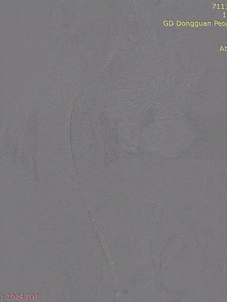 gore医疗怎么样「胸有乾坤」危如累卵 妙手回春——Conformable GORE®TAG®胸主动脉覆膜支架应用于高龄急性主动脉夹层治疗_https://www.jmylbn.com_新闻资讯_第28张