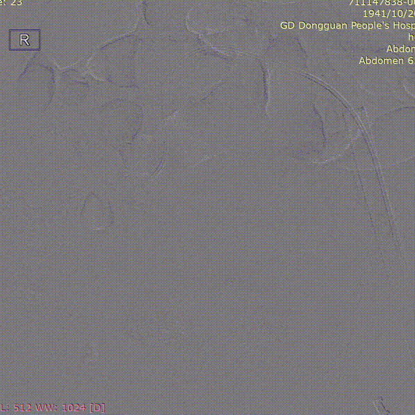 gore医疗怎么样「胸有乾坤」危如累卵 妙手回春——Conformable GORE®TAG®胸主动脉覆膜支架应用于高龄急性主动脉夹层治疗_https://www.jmylbn.com_新闻资讯_第37张